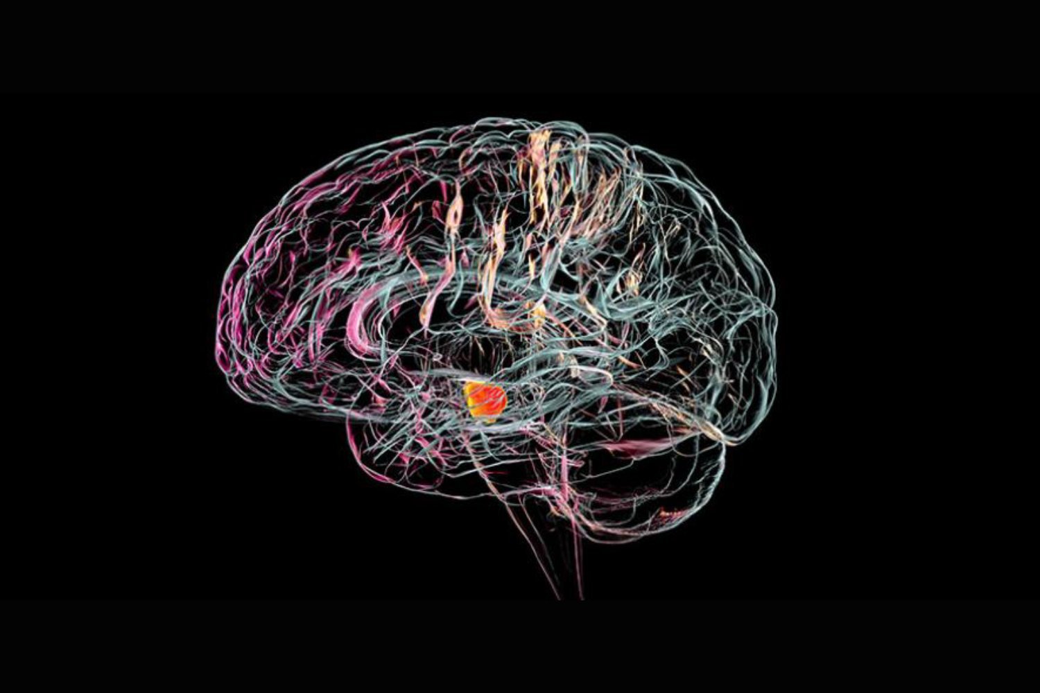 Brain Implant Illustration