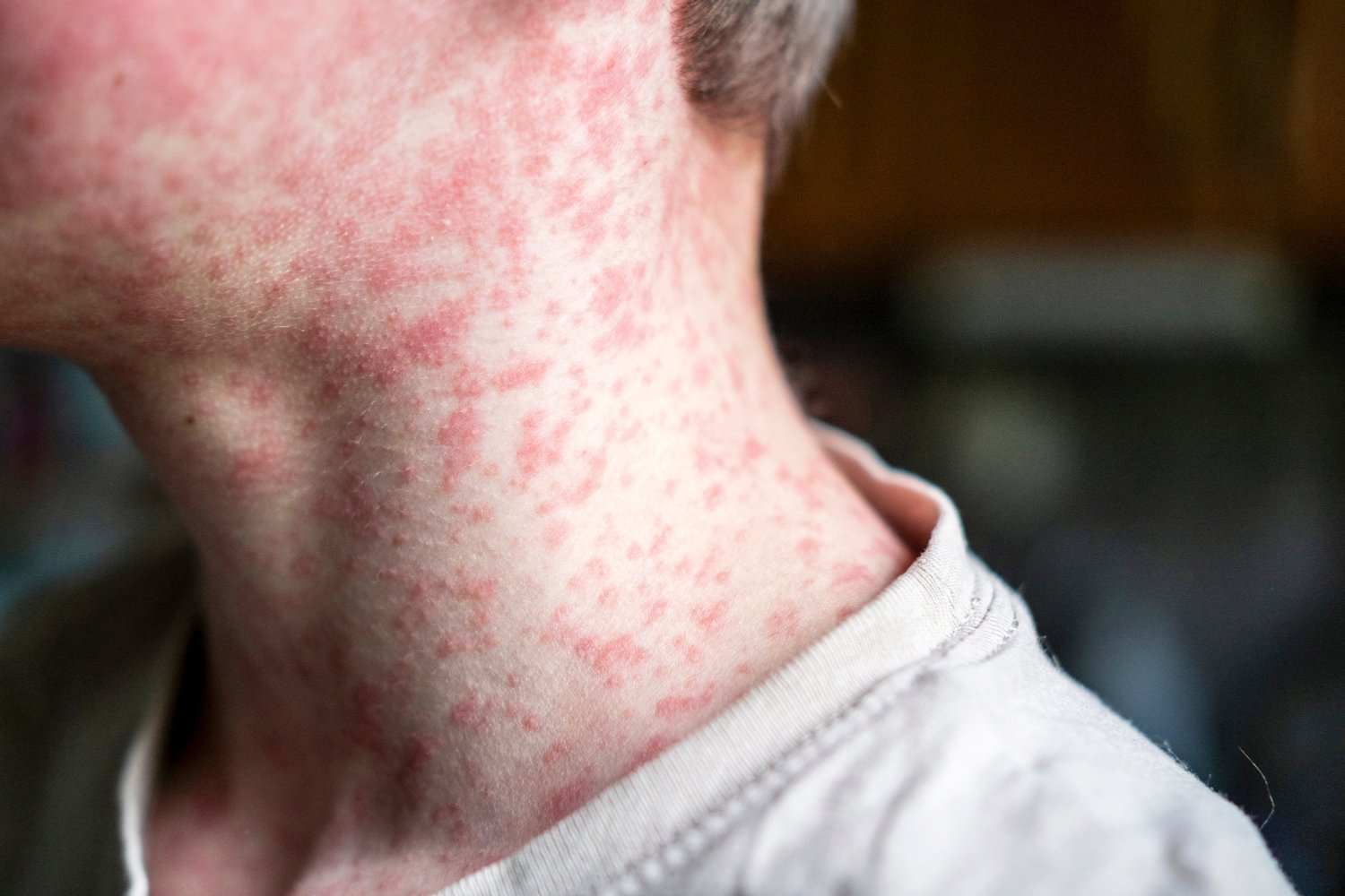 A teenager with a measles rash.